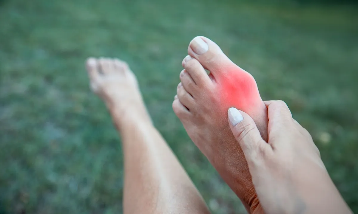 Bunions