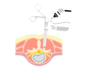 Endoscopic Discectomy