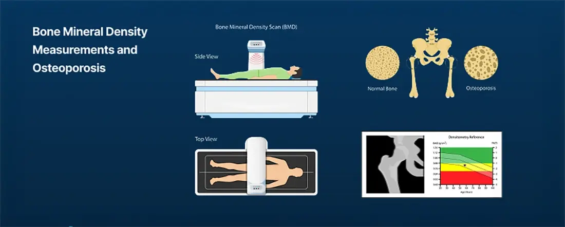 Diagnosing Osteoporosis