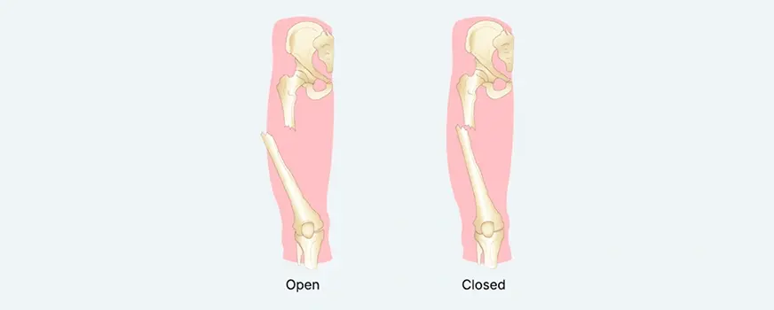 The Ultimate Guide to the Treatment of Fractures in Singapore