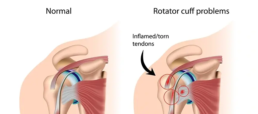 Causes of A Frozen Shoulder