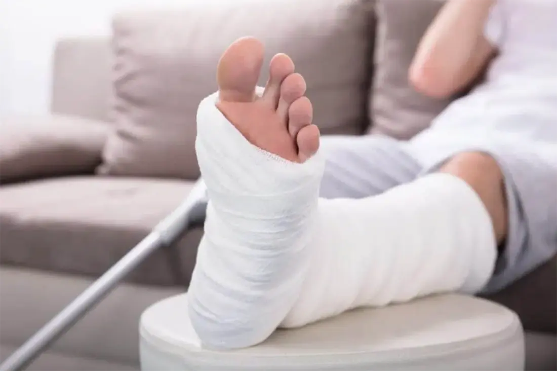 How to Care for Your Fracture