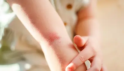 Supracondylar Fractures