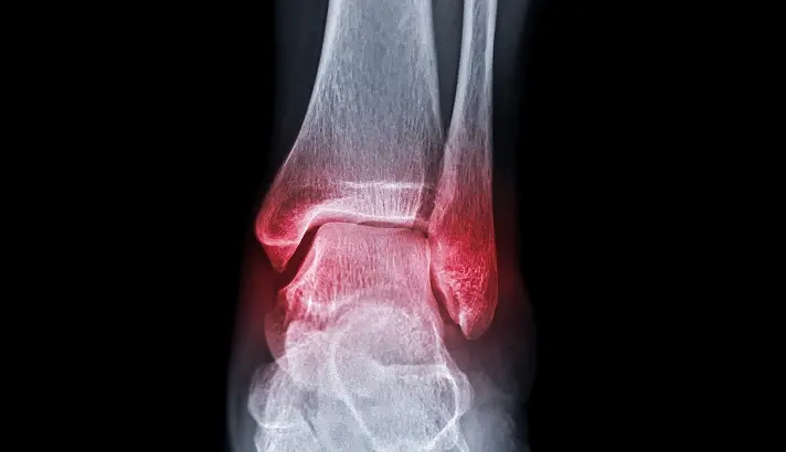 Bimalleolar and Trimalleolar Fractures