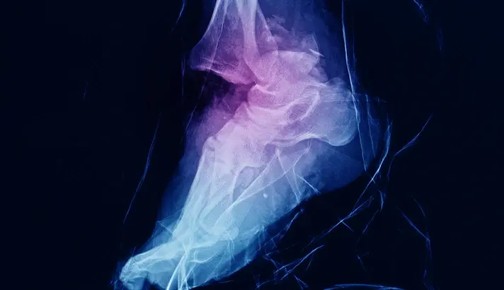Compound (Open) Fractures