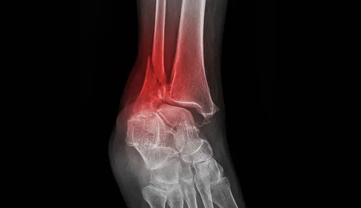 Unimalleolar Fracture
