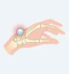 Dorsal Wrist Ganglion