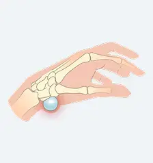Volar Wrist Cysts