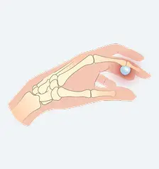 Volar Retinacular Cyst
