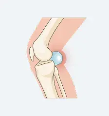 Ganglion Cysts Near Other Joints