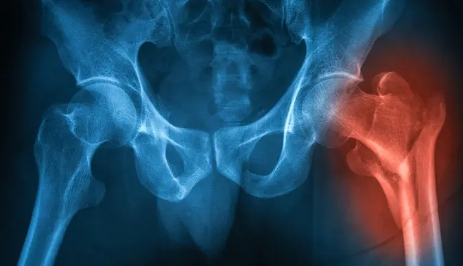 Femoral Neck Fracture