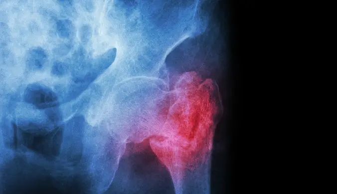 Intertrochanteric Fracture