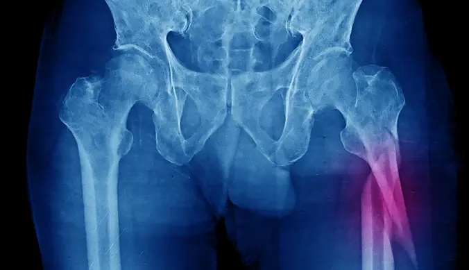 Subtrochanteric Fracture