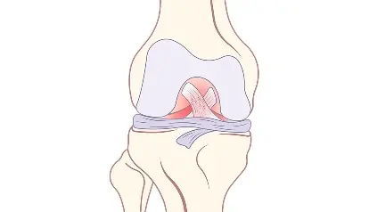 Superior Labrum Anterior and Posterior (SLAP) Tear