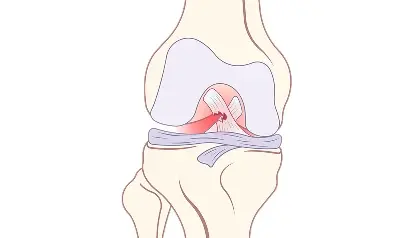 Superior Labrum Anterior and Posterior (SLAP) Tear