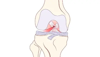 Superior Labrum Anterior and Posterior (SLAP) Tear