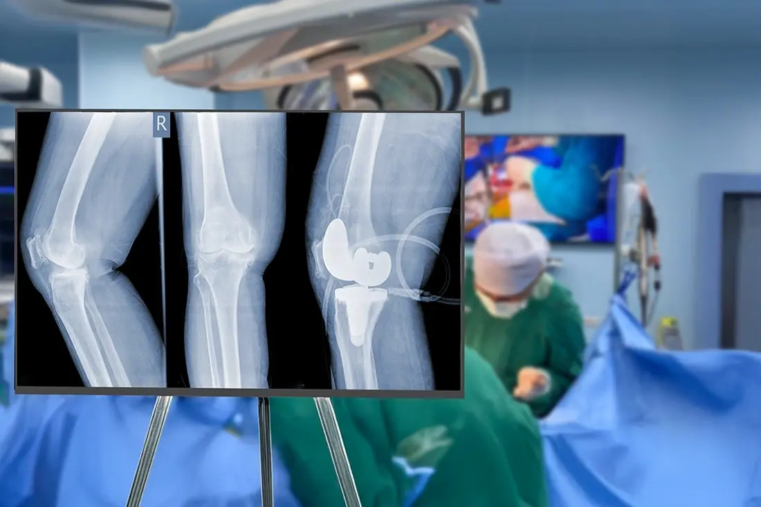 Knee Arthroscopy