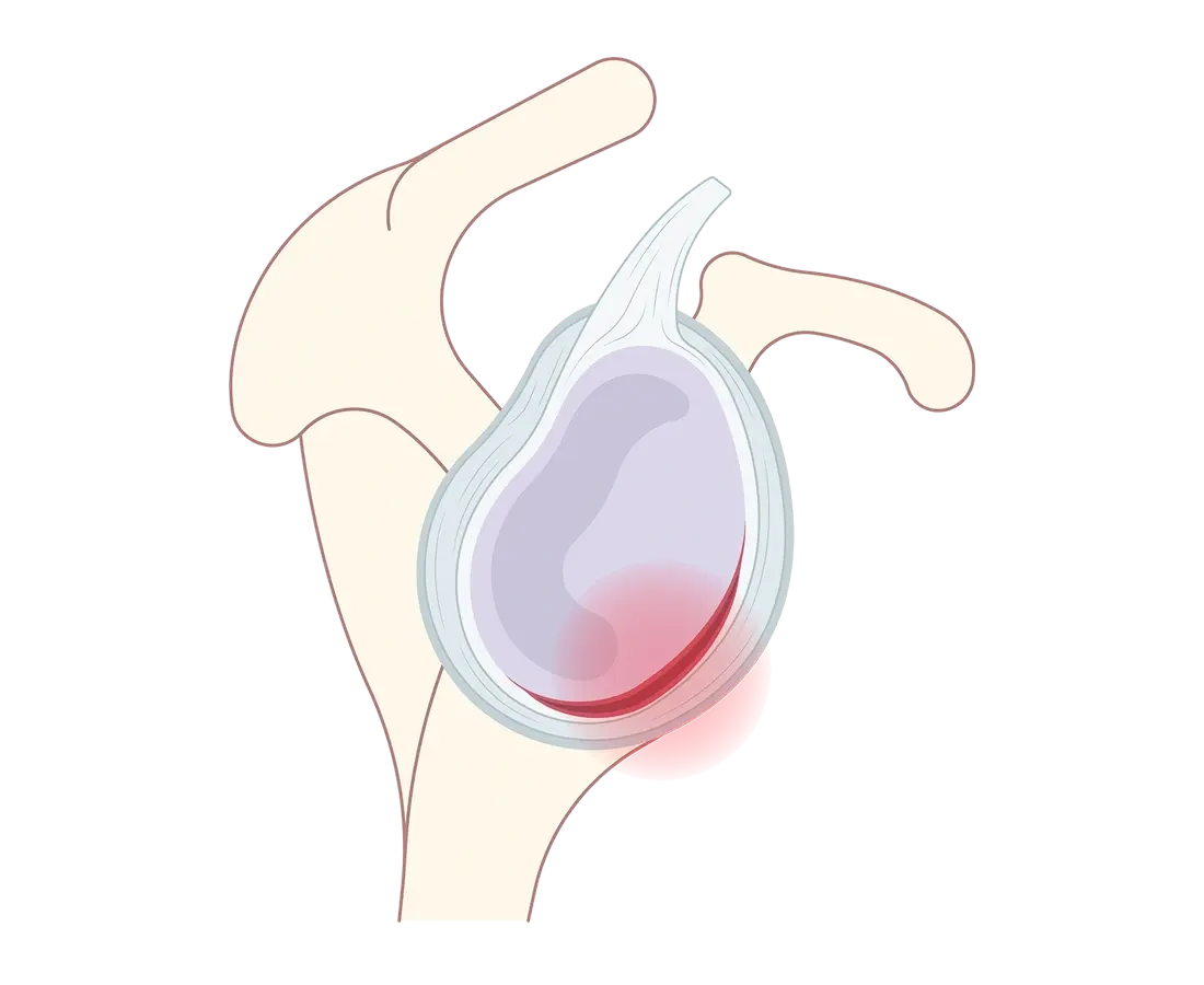 Superior Labrum Anterior and Posterior (SLAP) Tear