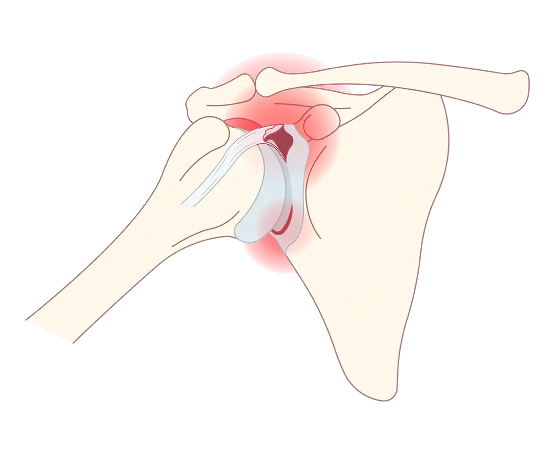 Superior Labrum Anterior and Posterior (SLAP) Tear