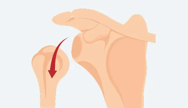 Superior Labrum Anterior and Posterior (SLAP) Tear