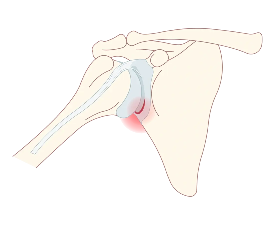 Superior Labrum Anterior and Posterior (SLAP) Tear