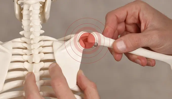 Superior Labrum Anterior and Posterior (SLAP) Tear