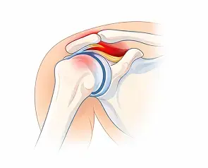 External (Subacromial) Impingement