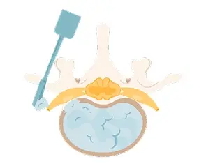 Microdiscectomy