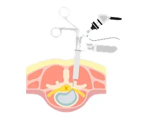 Endoscopic Discectomy