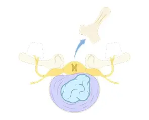 Laminectomy or Laminotomy