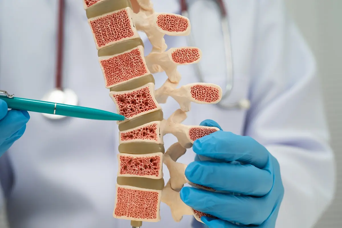 What Are the Risk Factors for Geriatric Fractures?