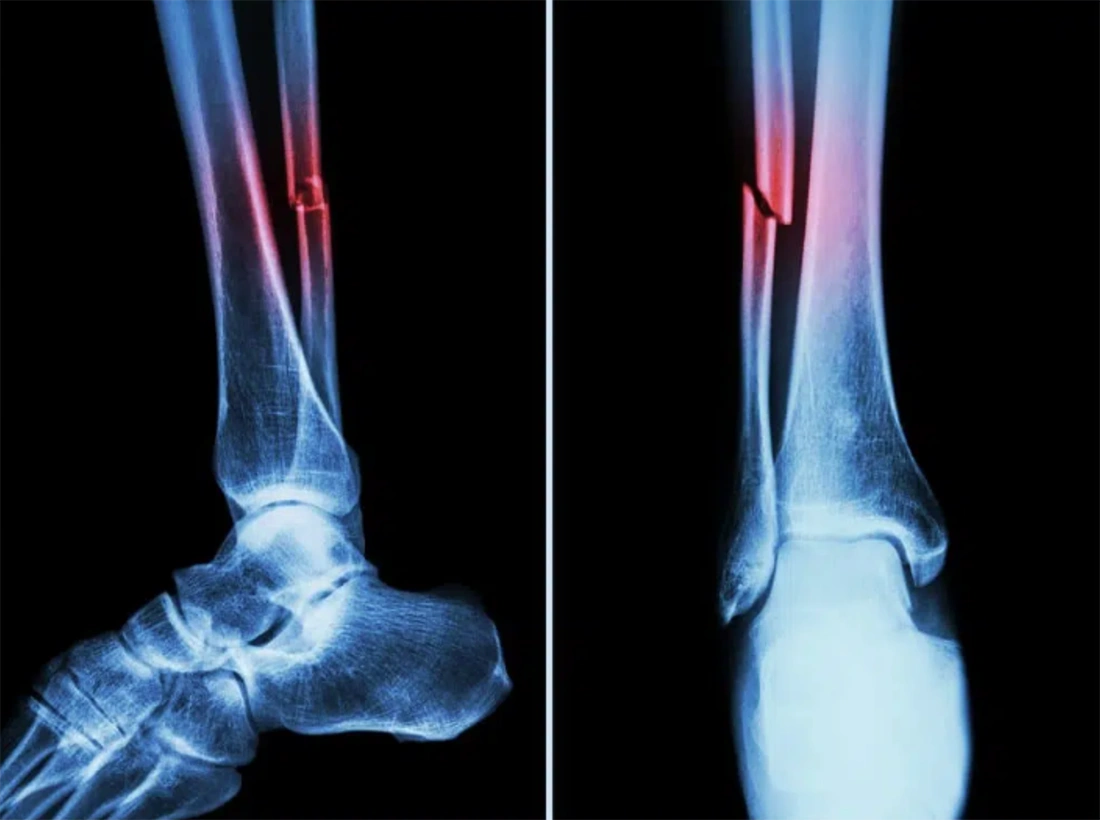 Inflammation Stage