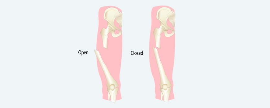 The Ultimate Guide to the Treatment of Fractures in Singapore