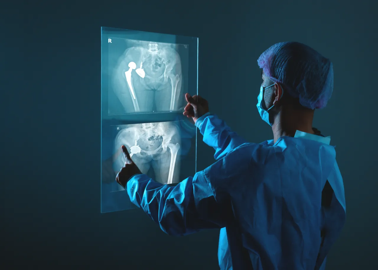 Doctor looking at X-Ray to determine hip replacement placement
