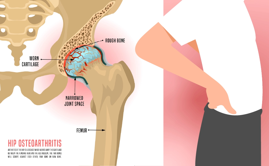 Osteoarthritis