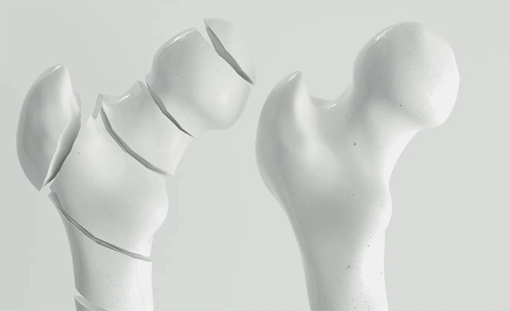 Understanding Osteoporosis