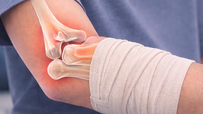 Simple Elbow Dislocation