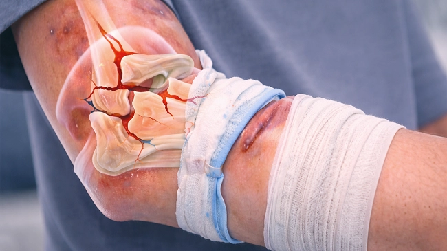 Complex Elbow Dislocation