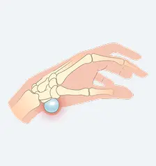 Volar Wrist Cysts