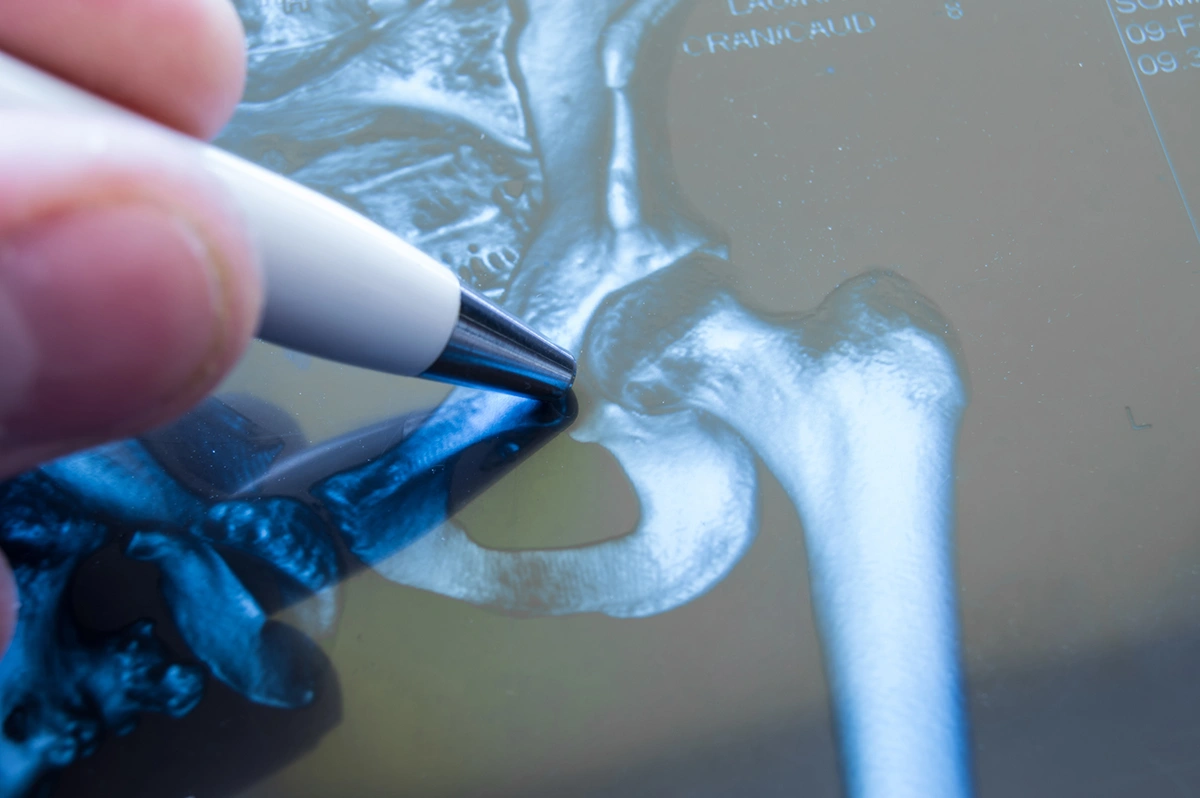 How Are Hip Fractures Diagnosed?