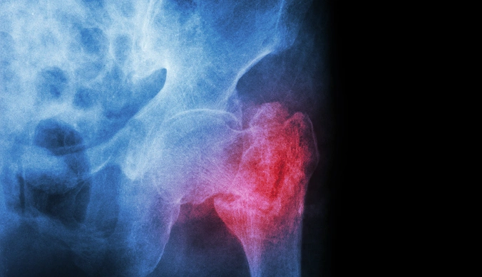 Intertrochanteric Fracture