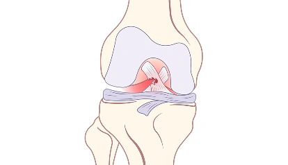 Superior Labrum Anterior and Posterior (SLAP) Tear