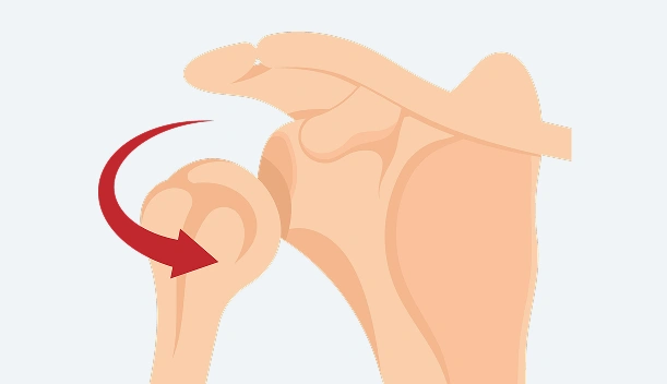 Superior Labrum Anterior and Posterior (SLAP) Tear