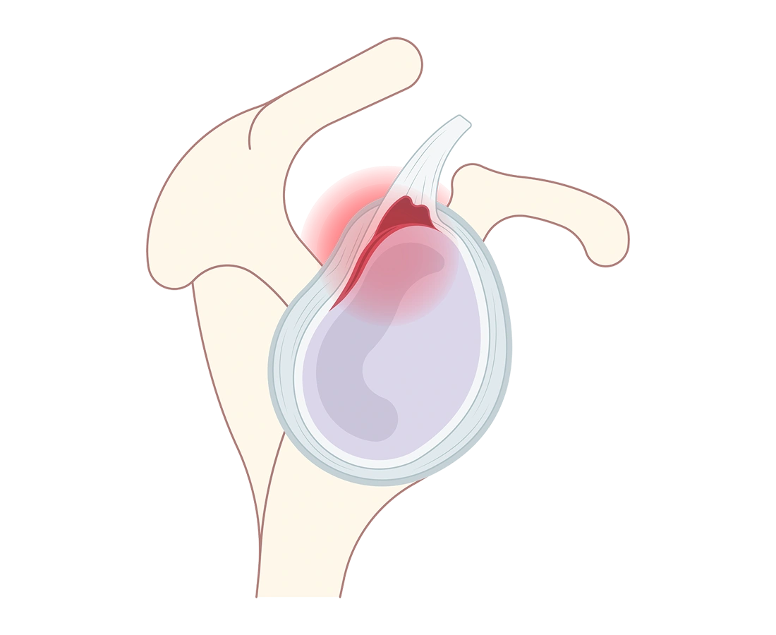 Superior Labrum Anterior and Posterior (SLAP) Tear