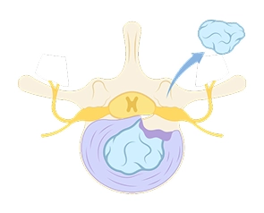 Discectomy