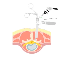 Endoscopic Discectomy