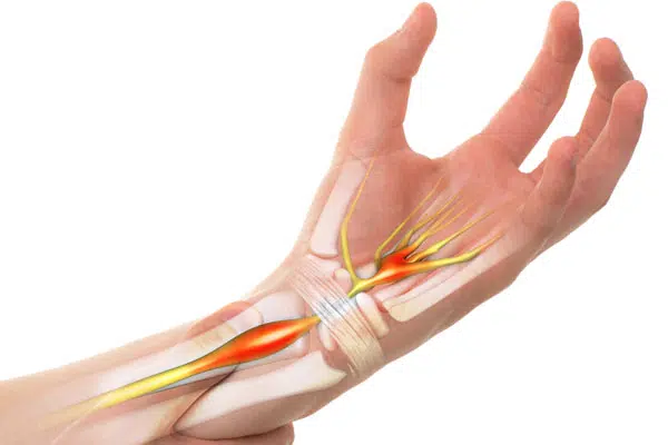 Carpal-Tunnel-Syndrome2