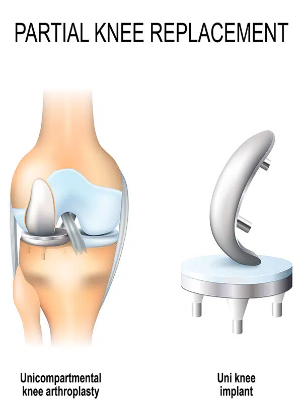 partial knee replacements graphic