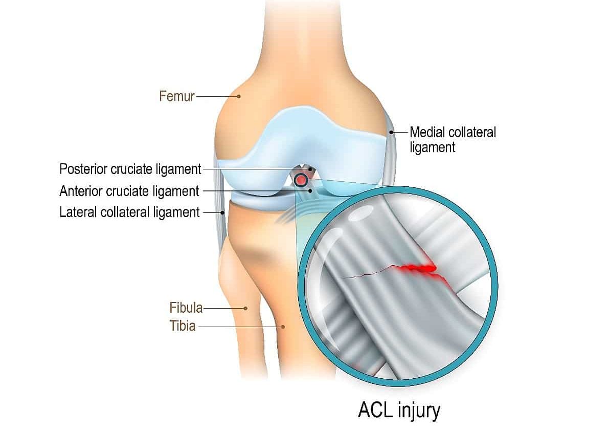 What is the ACL